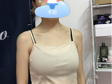 项力源哺乳后丰胸