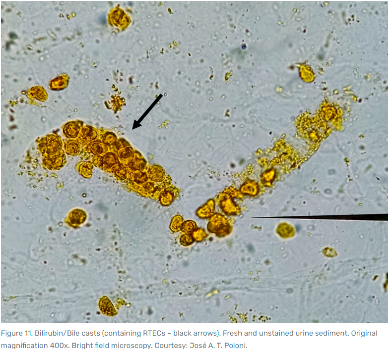 尿液显微镜检查:识别多种色素管型及其与肾脏损伤的关系
