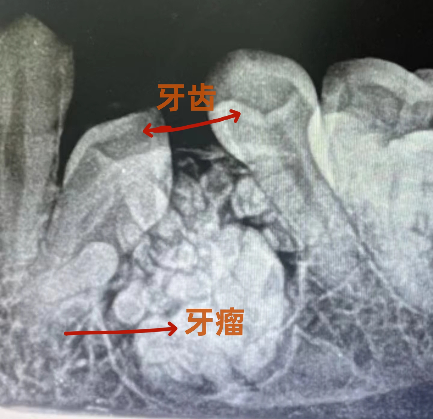 牙骨质瘤影像图片图片