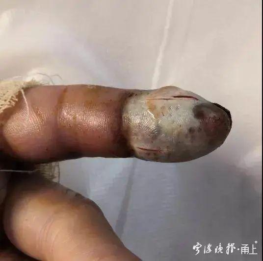 有人被它咬了4口后死亡!医生提醒:与它遭遇时千万别这样做