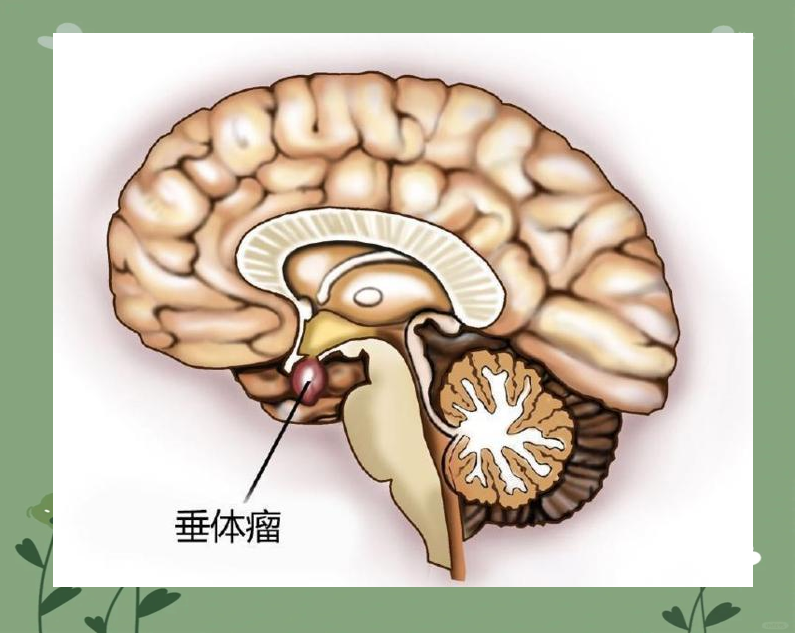 垂体瘤导致容貌变丑,体型增胖,月经失调及视力下降等多种症状