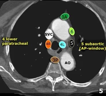 重要图文:纵隔淋巴结的分区(iaslc)