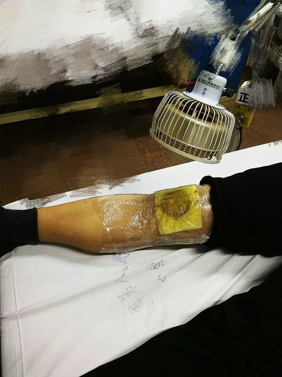 技术|青岛市第八人民医院中药塌渍法治疗膝骨关节病