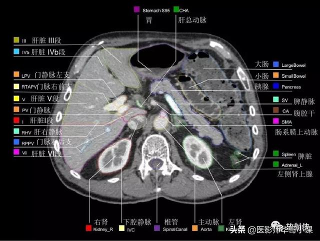 「高清ct图」上腹部及血管ct断层解剖