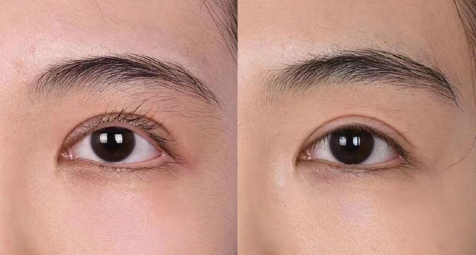 双眼皮术后出现上眼睑外翻怎么修复