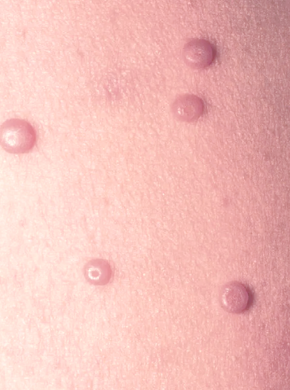 健康提醒:玩水上乐园需警惕,多娃感染传染性软疣