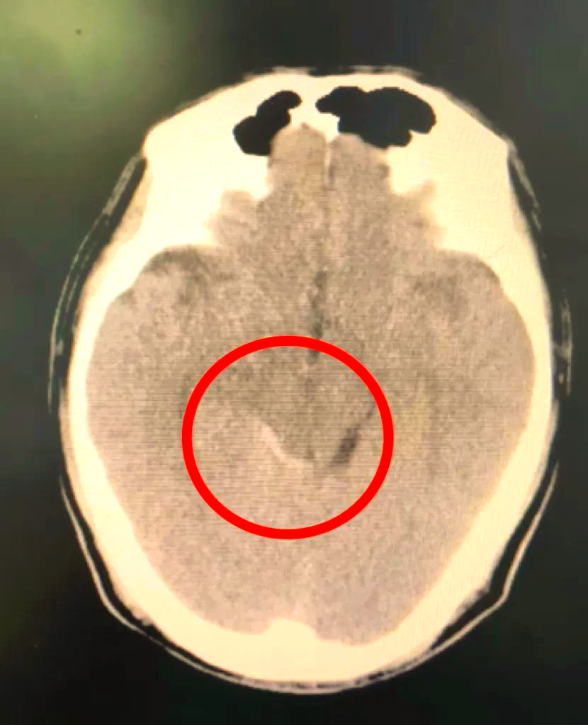 脑动脉瘤:一种脾气暴躁的疾病,随时可能"爆发"!