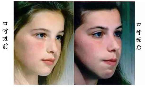 10个孩子3个用嘴呼吸,不仅会龅牙变丑还会拉低智商,请快速矫正