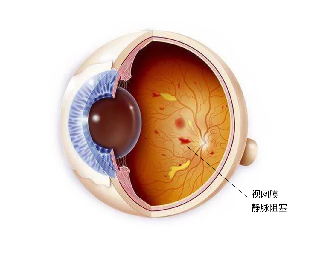 你了解视网膜静脉阻塞吗?