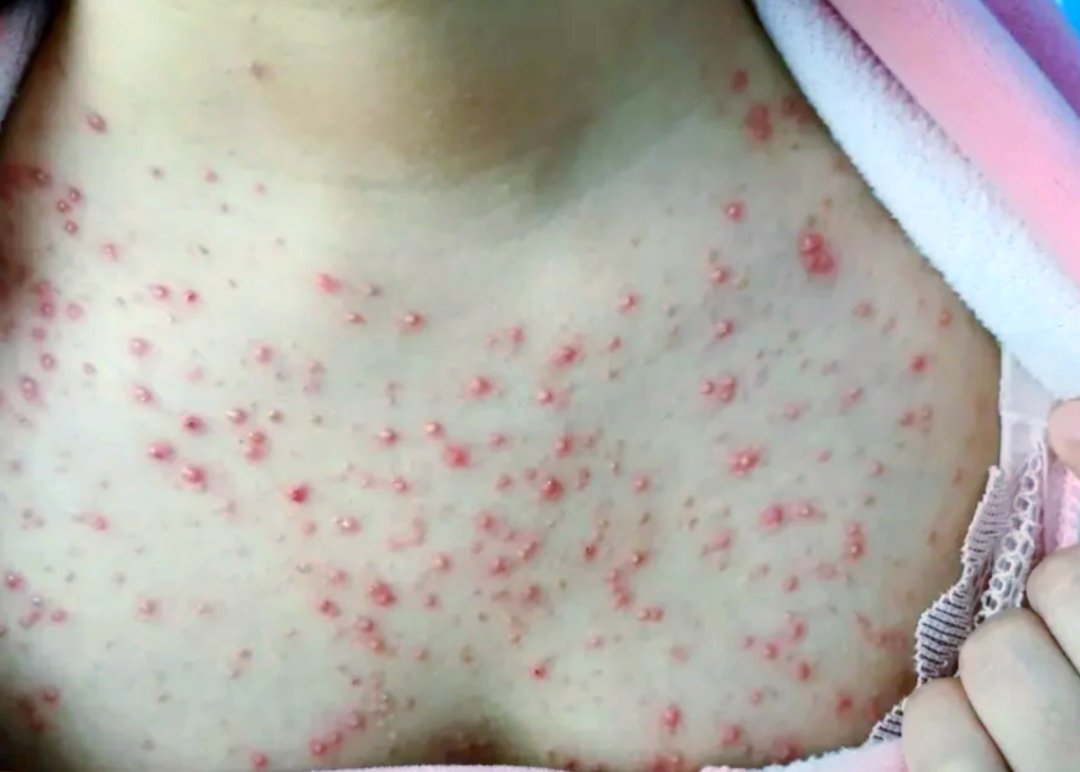毛囊炎后期可能演变为硬疙瘩,肌肤健康需警惕!