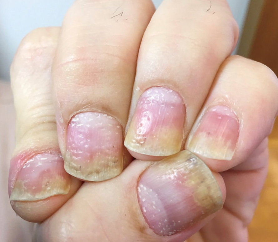 银屑病中的甲损害与甲点状凹陷深度解析