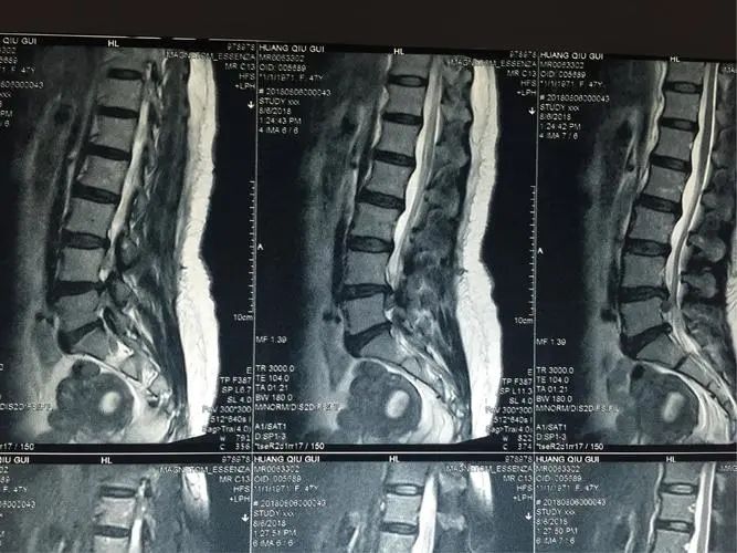 看完我哭了 腰突症最佳治愈经验大揭秘