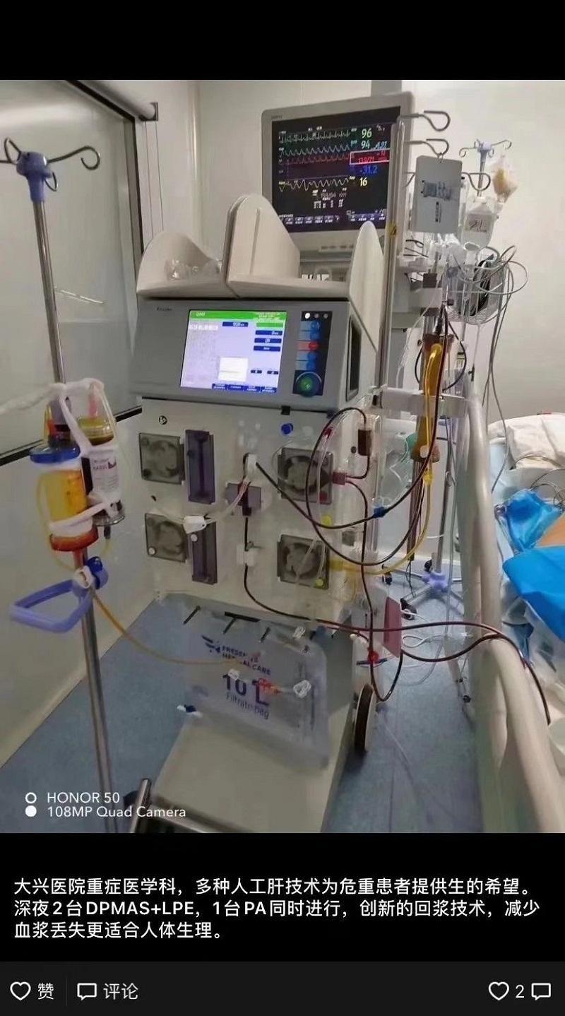 "人工肝plus"成肝衰竭救治新技术