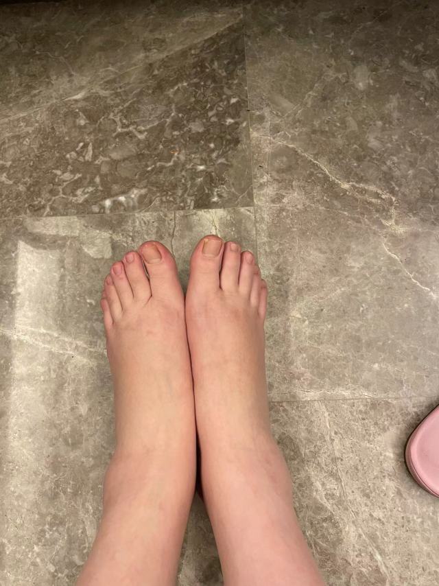 本来回家歇歇脚的"大白",走到家门却……这双肿脚丫让人破防