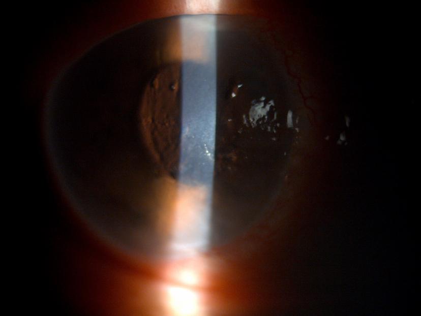 【健康】角膜浑浊谨防视神经萎缩