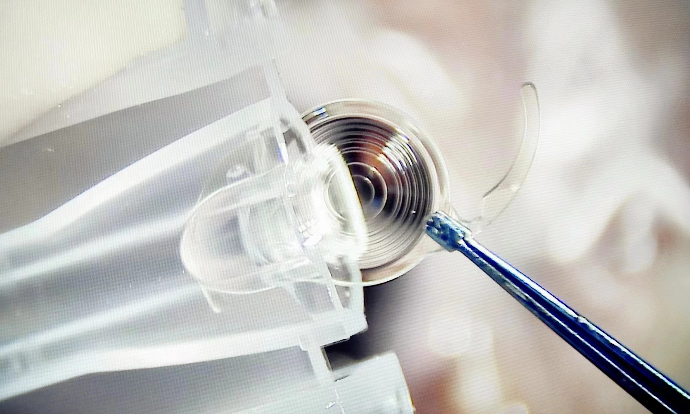 全球首款提供33厘米近视力的连续视程人工晶状体完成国内首台手术植入