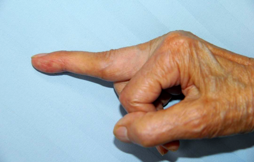 在医学临床中,手指的"天鹅颈"畸形被定义为由多种