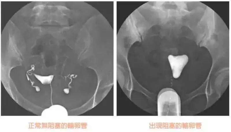 正常人输卵管造影片子图片