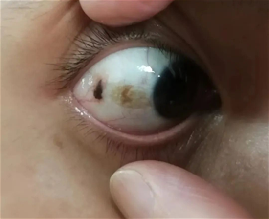 相亲姑娘一句话让杭州小伙慌了神眼睛里有颗"痣"还"发霉"了