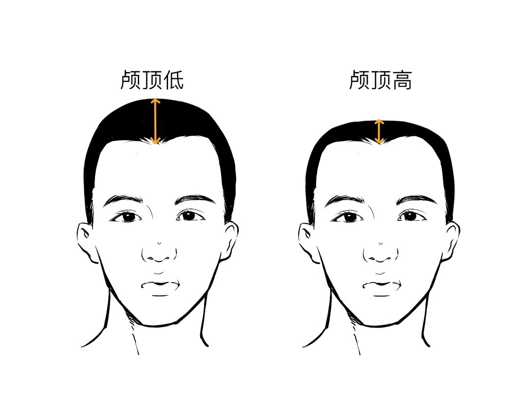 发际线秃了