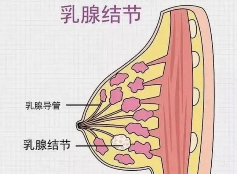 乳腺结节恶化前都有哪些征兆?