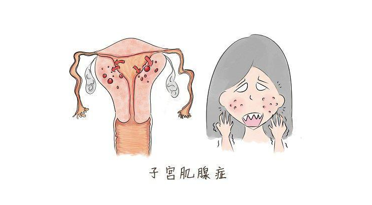 腺肌症卡通图片