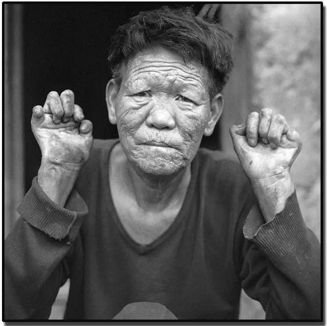 全面消除麻风危害,共同走向文明进步