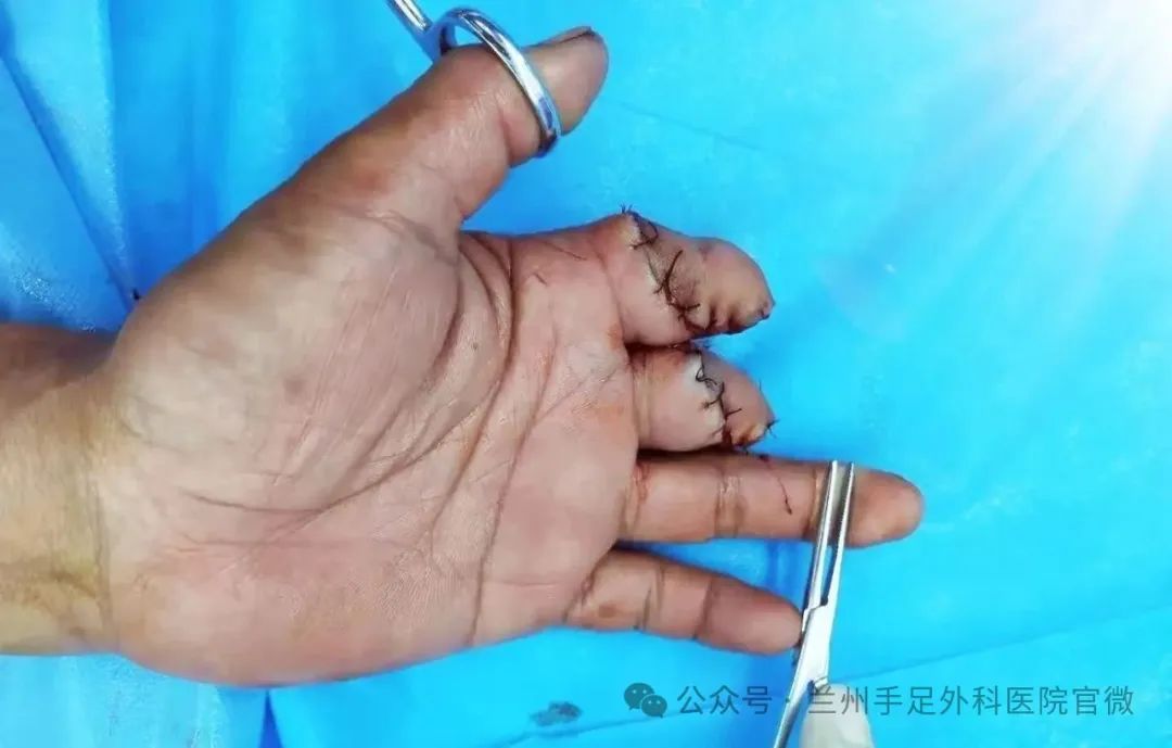 应用废弃指组织选取皮瓣覆盖伤指残端创面