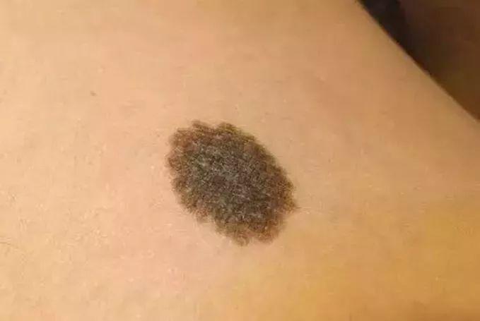 雀斑,蒙古斑与黑色素痣的诊断与治疗