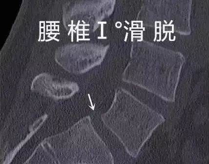 腰椎滑脱程度的分级图解