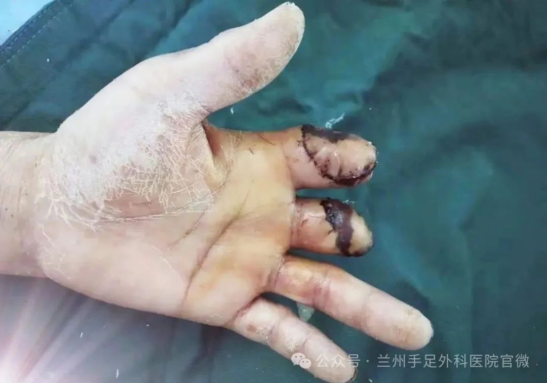 应用废弃指组织选取皮瓣覆盖伤指残端创面