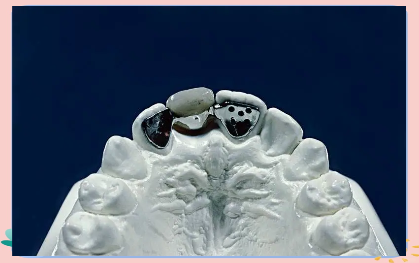 全面了解马里兰桥:掌握其应用与优缺点