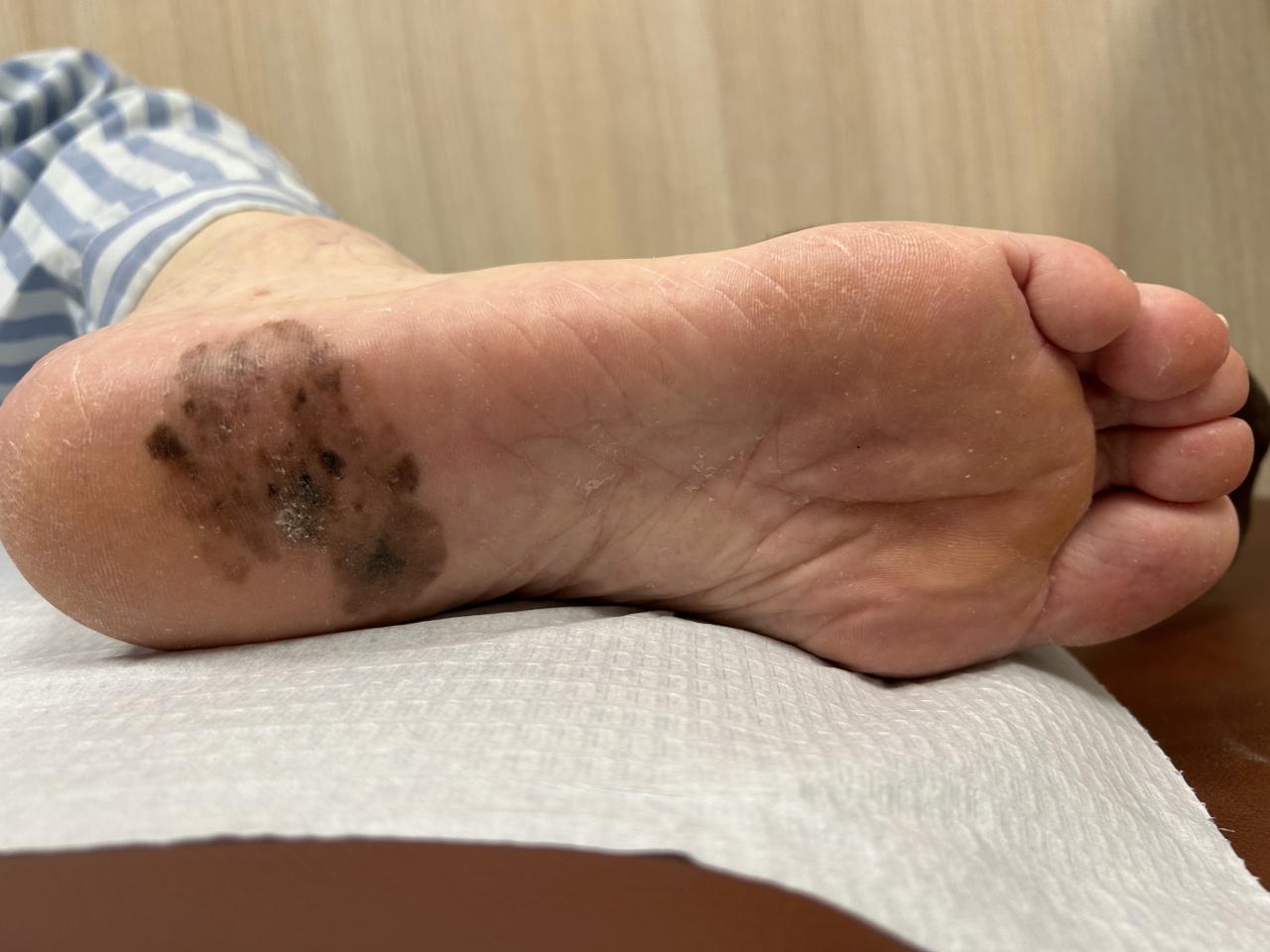 好声音亚军张恒远因黑色素瘤离去,不少年轻人慌忙赶去皮肤科:"快帮我