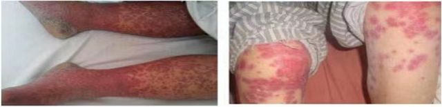 拉莫三嗪的黑暗自爆——千万别小瞧我"皮疹反应"哦