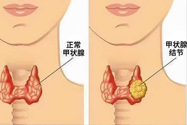 甲状腺结节4级,医生说让观察,最后居然有癌变的可能了?