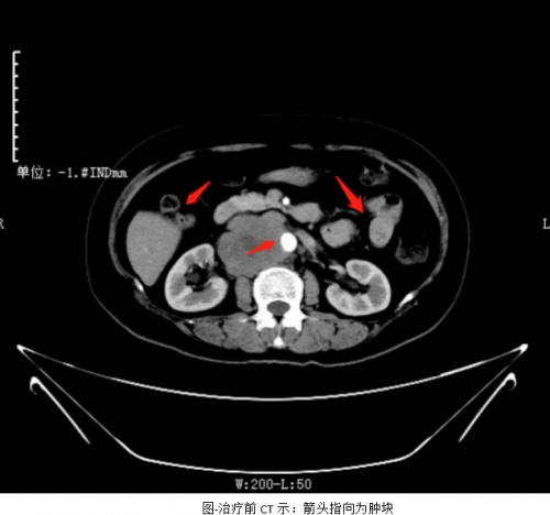 宫颈癌的ct影像表现图片