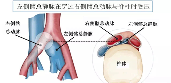 髂内外动脉图片