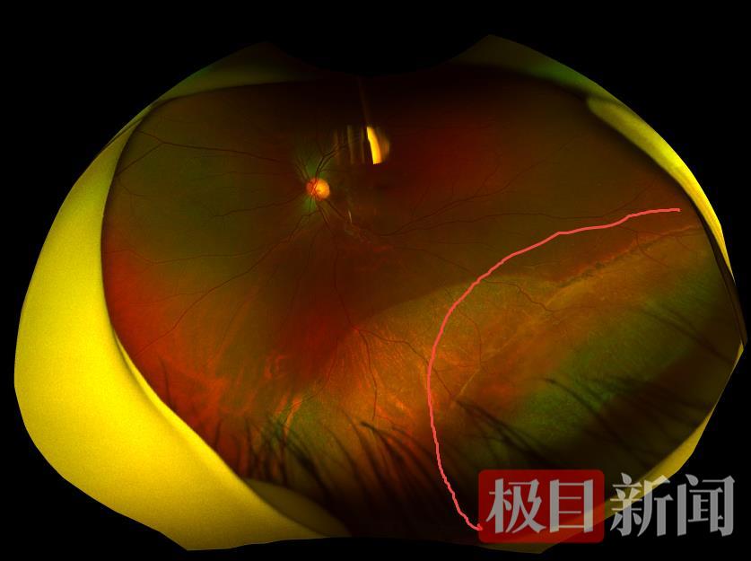 22岁小伙矫正斜视却意外发现视网膜脱离,专家:外伤或为隐形"导火索"