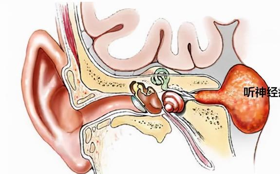 提醒:身体出现4个症状表现,多半听神经瘤找上门,尽早就医