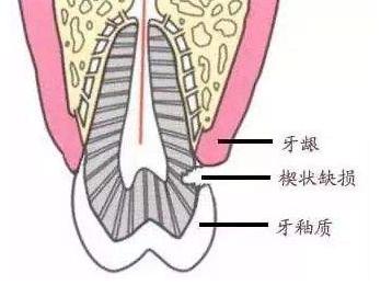 双尖牙的位置图图片