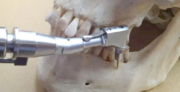 正畸支抗钉植入部位选择及注意事项