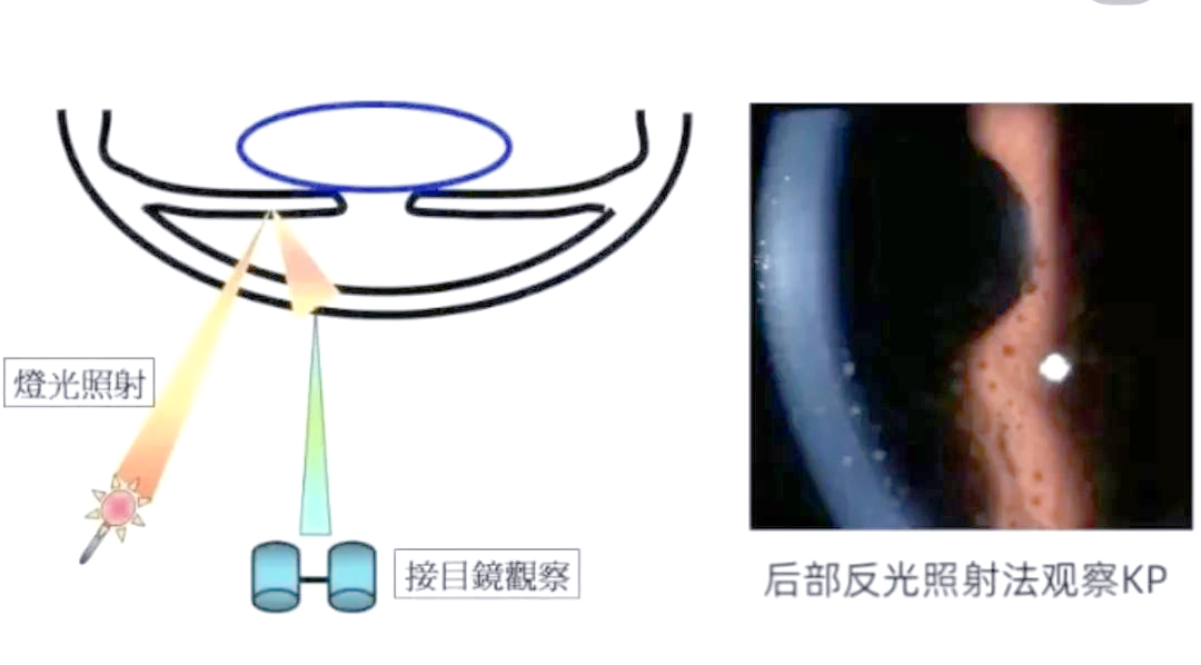 裂隙灯的多种照明方法介绍
