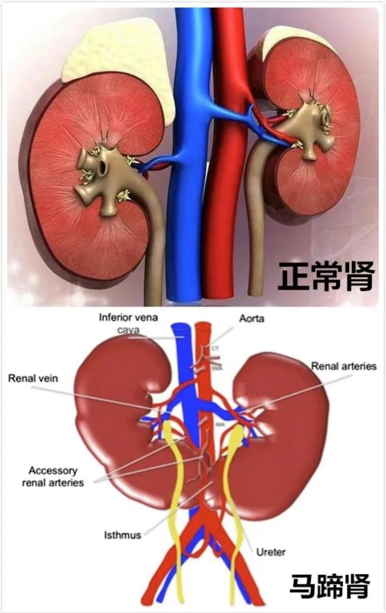 马蹄肾与正常肾图片图片