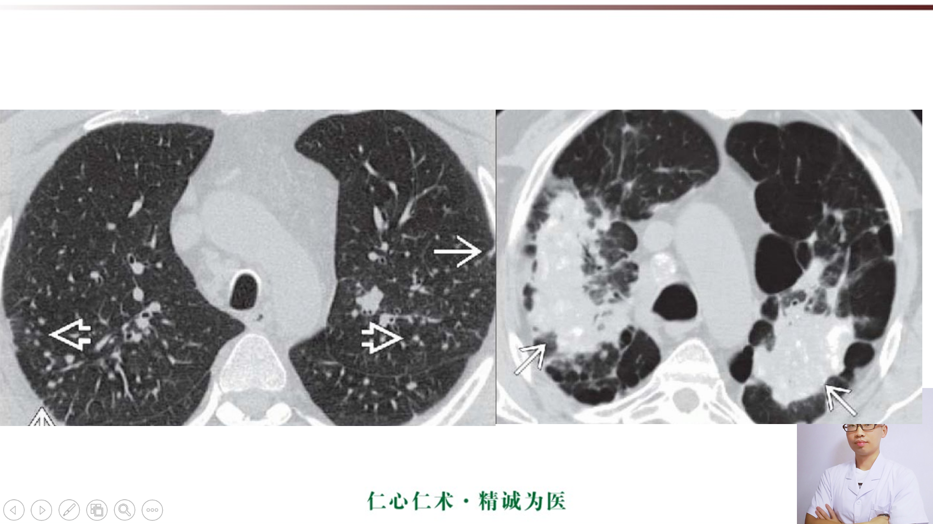 矽肺病ct表現及報告書寫!