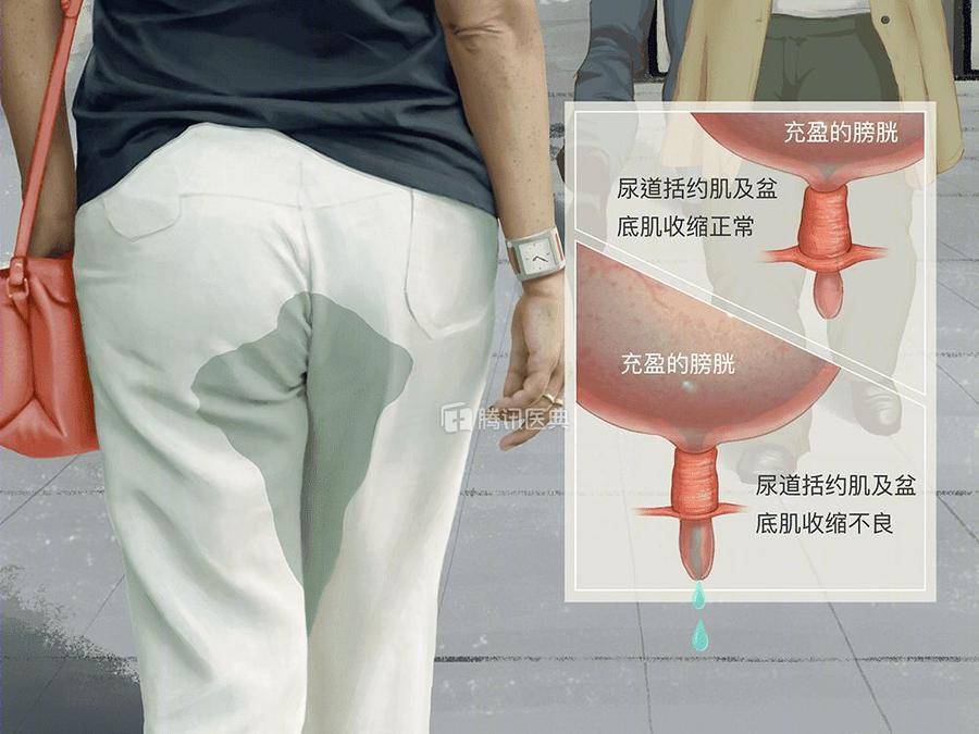 中重度的压力性尿失禁手术治疗有金术式,轻松告别漏尿!
