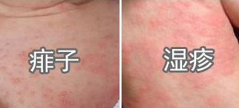 王利兰:湿疹和热疹的区别图片