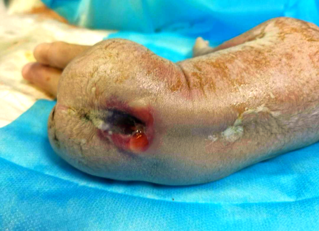 胎儿开放性脊柱裂的超声诊断与社会影响