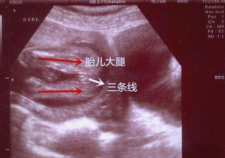 当然,这需要b超医师能够准确看到胎儿的关键部位