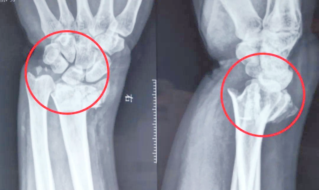 多例骨折治疗前后对比