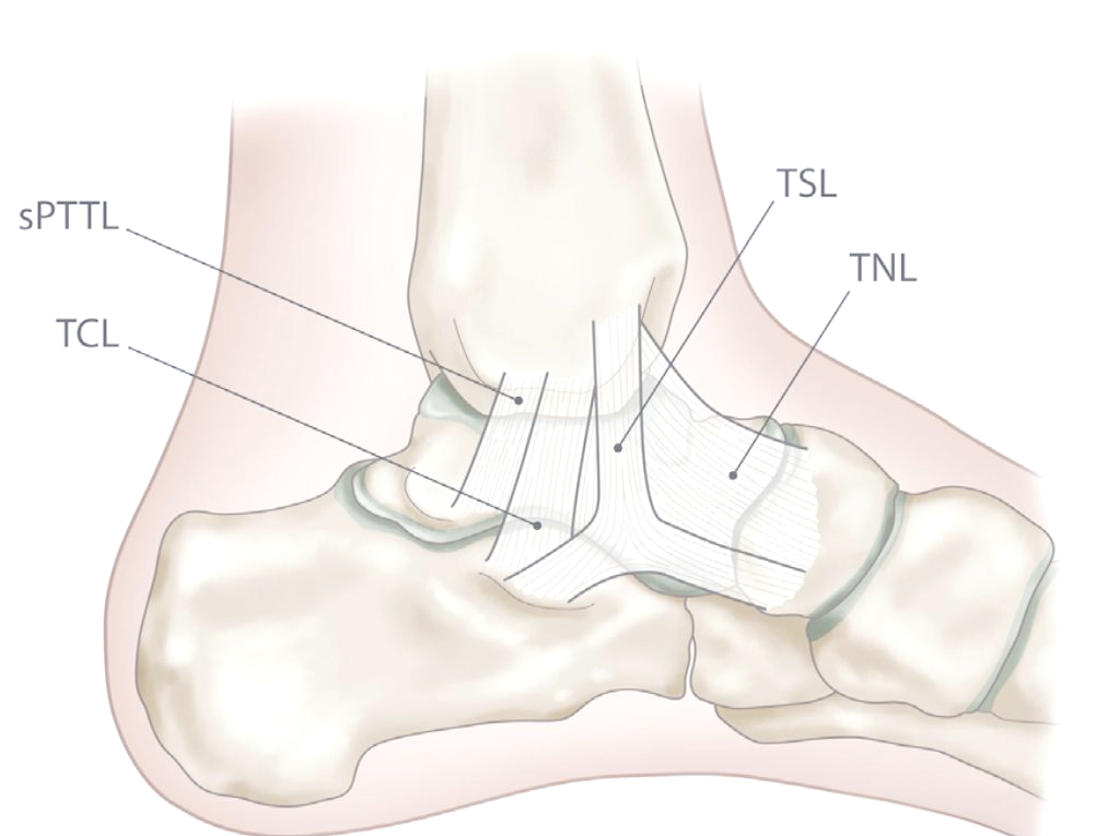 踝关节骨折中三角韧带修复的适应症与技巧
